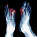 Amputation for Severe Diabetic Neuropathy: Understanding Treatment Options